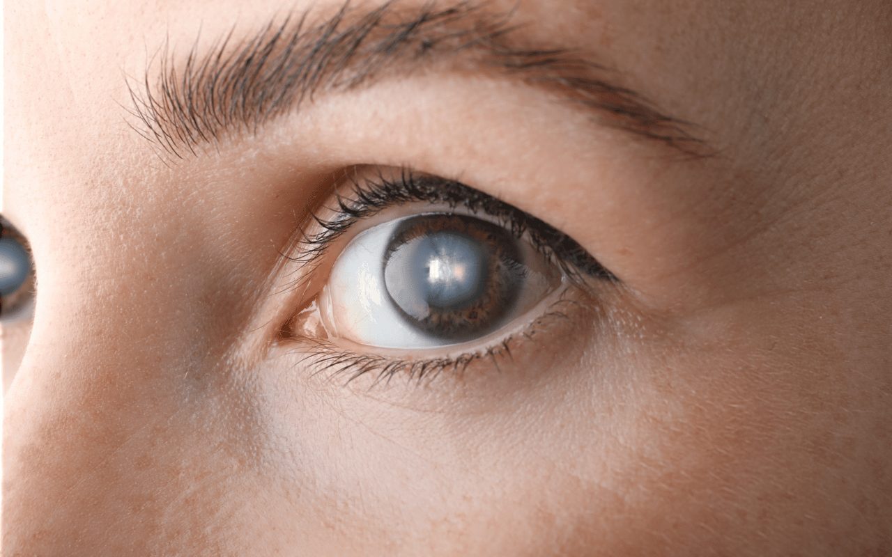 femme Cataracte risque perte vision