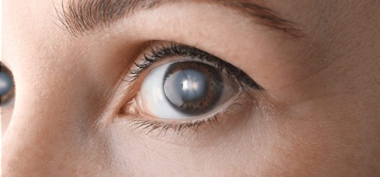 Cataracte : Faut-il redouter la perte de vision ?