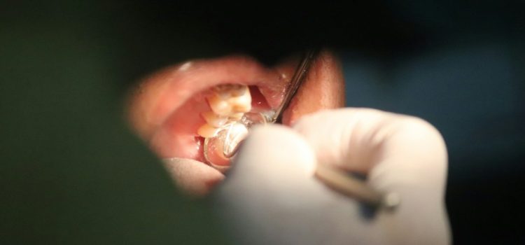 La lutte contre le tartre dentaire : une nécessité pour votre santé bucco-dentaire